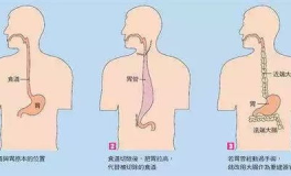 食管癌治疗,食管癌治疗策略与综合治疗方案详解